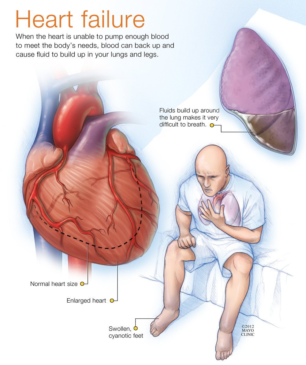 Heart Not Pumping Enough Blood To Kidneys