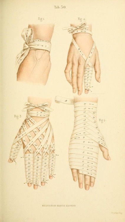 floresetmanus:

Manual of Surgical Bandages, Devices and Dressings
1859

