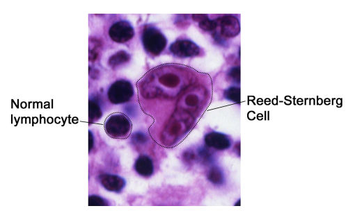 Giant cell tumor distal radius