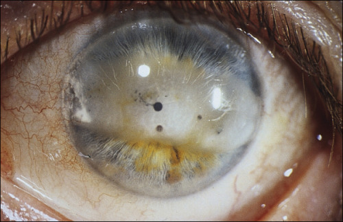 smellslikecadaverine: Band keratopathy involving the interpalpebral cornea in a patient with pauciarticular juvenile idiopathic arthritis and chronic anterior uveitis. 