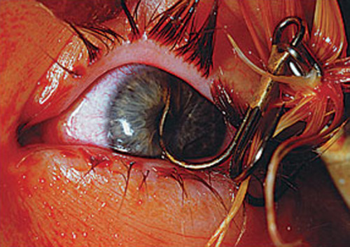eyedefects: Fishing hook in the left eye. 