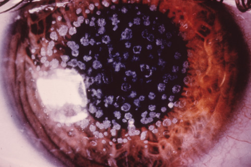 eyedefects: Cornea with granular dystrophy.