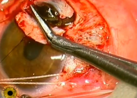 pulchritudinous-cadaver:

Eye surgery II
